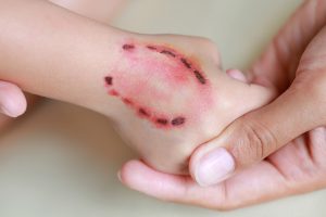 У Запоріжжі 7 дітей постраждали від укусів тварин
