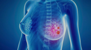 МОЗ додало препарати проти раку молочної залози до програми “Доступні ліки”: що треба знати запоріжцям