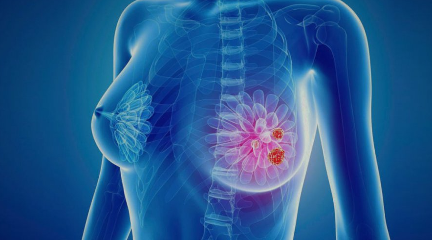 ChatGPT сказал: МОЗ додало препарати проти раку молочної залози до програми “Доступні ліки”